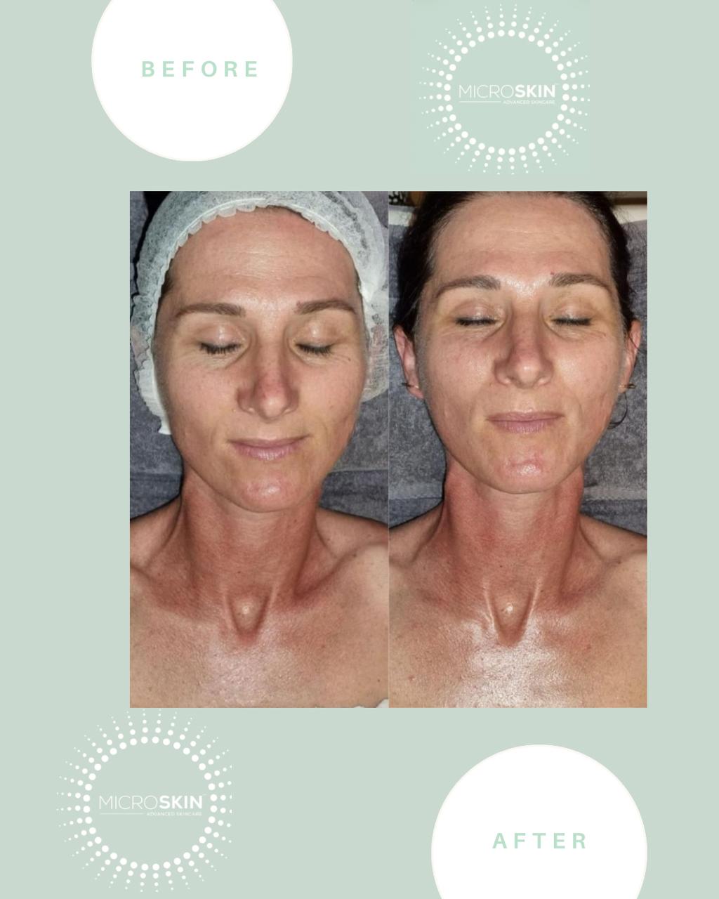 Microskin Transformation